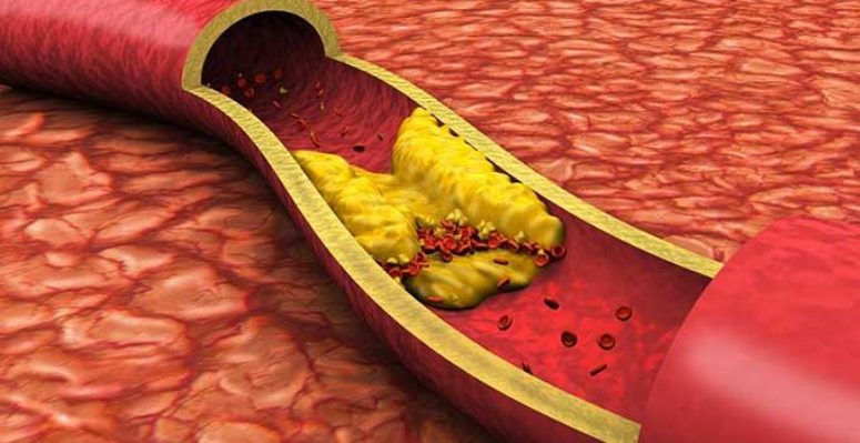 Атеросклероз поражает сосуды, преимущественно артерии